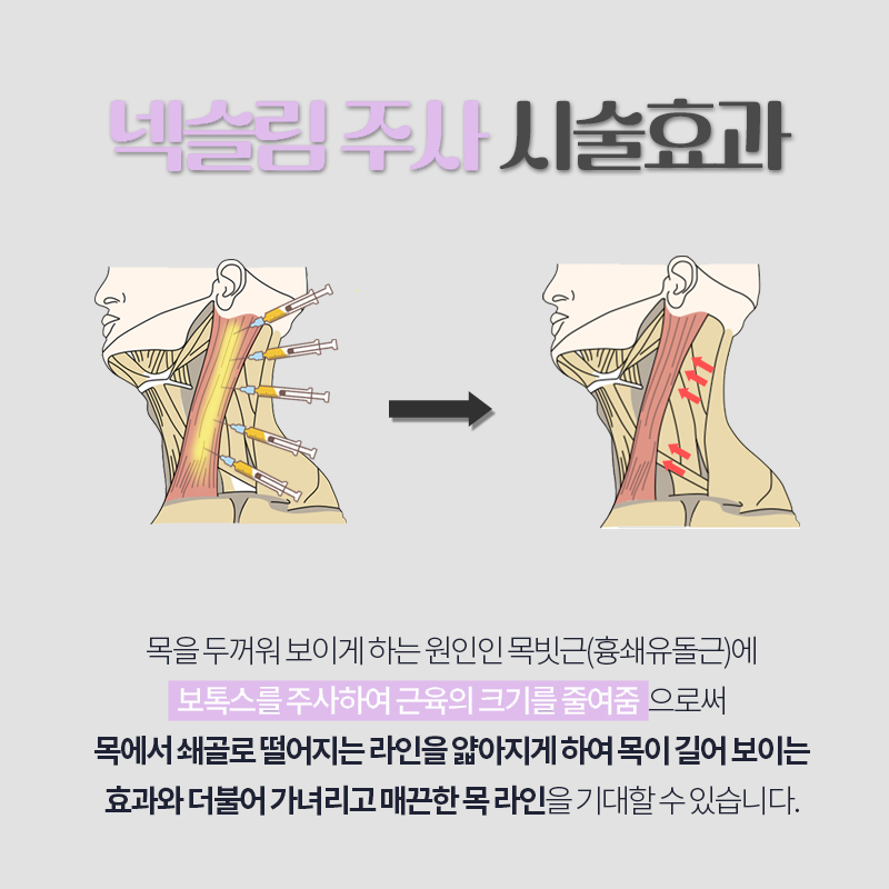 역대급 넥슬림주사전후 차이 궁금하다면 관련 이미지 3