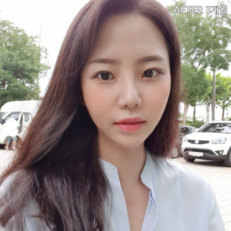 김형진베이직 얼굴지흡효과 좋다 좋아 관련 이미지 7