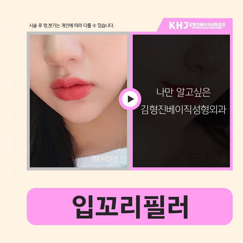 입꼬리필러로 부드럽게 입꼬리올리는방법 관련 이미지 5
