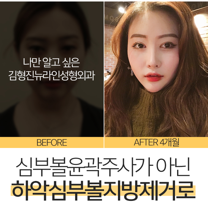 심부볼윤곽주사 누가 가능하대? 관련 이미지 5