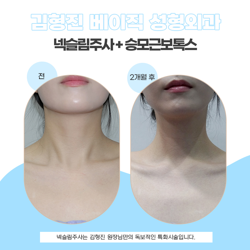 넥슬림주사로 가녀린 목 어깨 만들기 관련 이미지 5