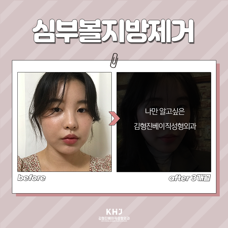 심부볼지방제거후기 보고 가세요! 관련 이미지 3