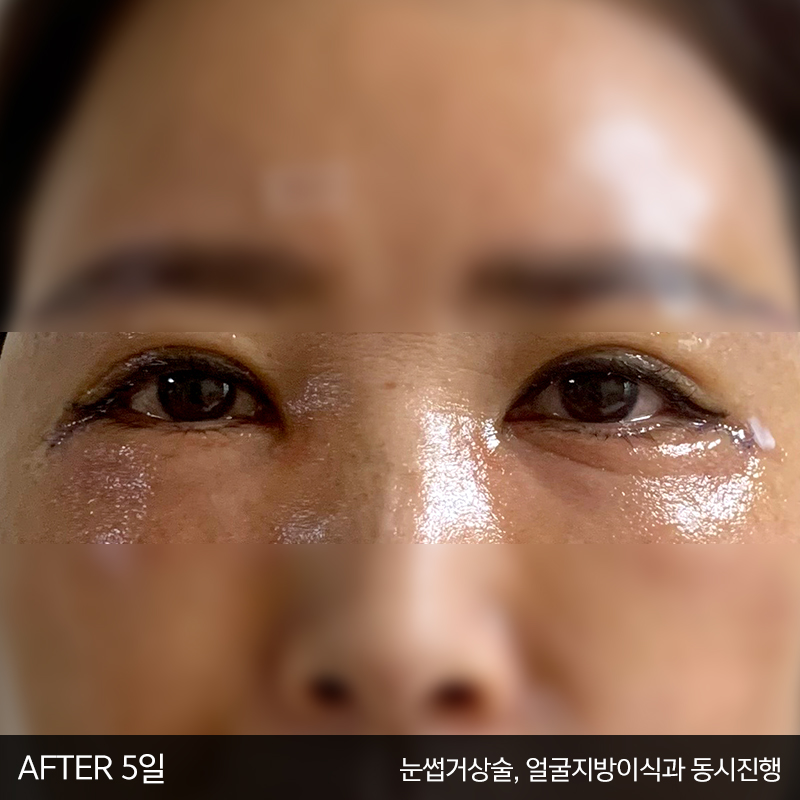 중년눈밑처짐 해결방법은 관련 이미지 4