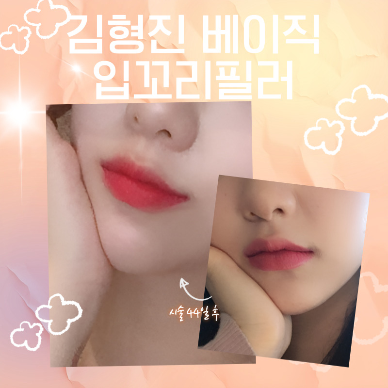 입꼬리필러시술로 자연스럽게 미소 띈 인상을 만들어요! 관련 이미지 4