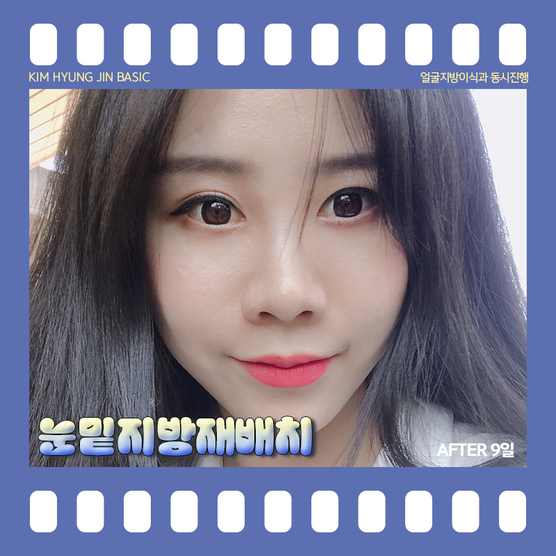 눈밑지방재배치통증! 걱정 안해도 되는 이유 관련 이미지 4
