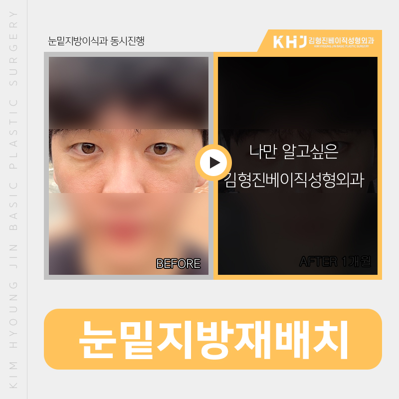 눈밑지방재배치레이저 티 안나게 해야죠 관련 이미지 3