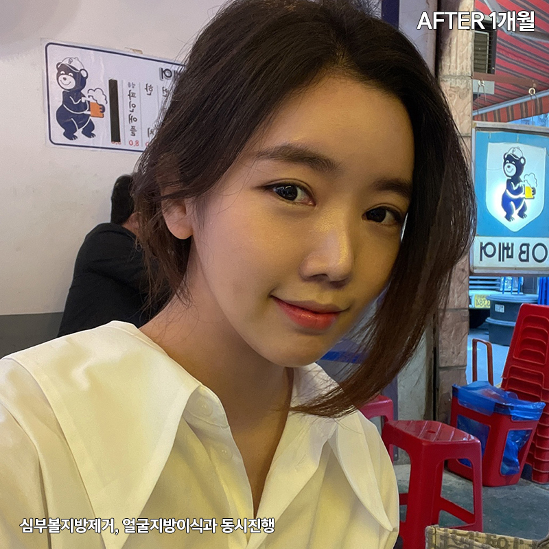 턱지방흡입 처짐 없는 김형진베이직 관련 이미지 5