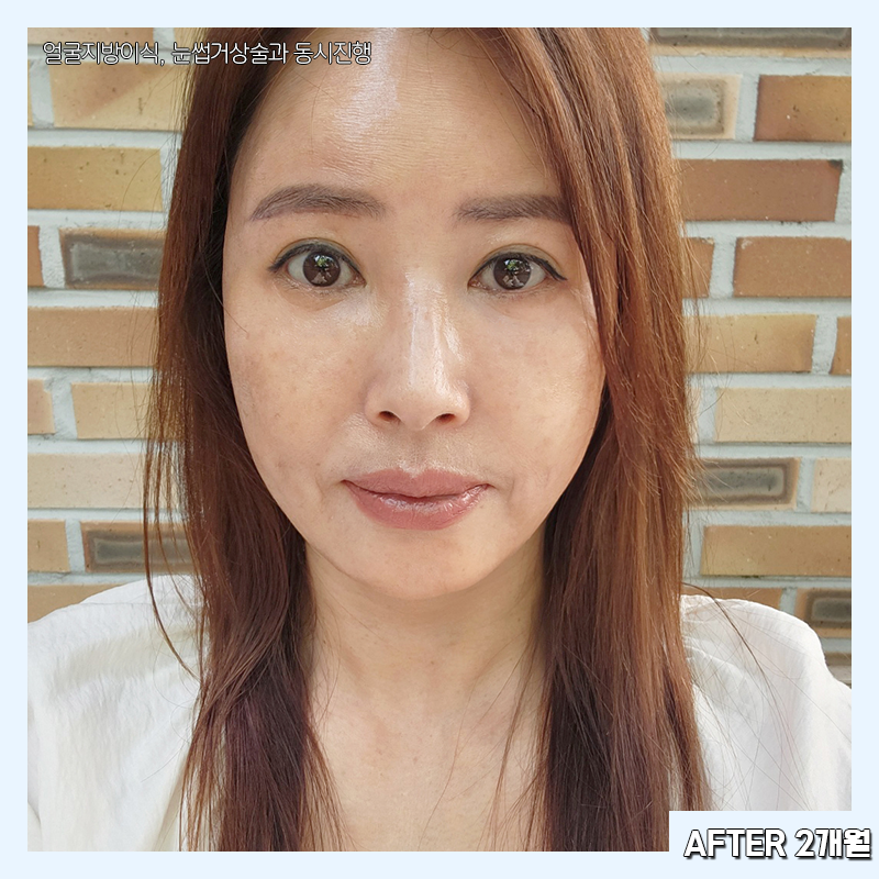 미니하안검흉터 걱정할 필요 없어요 관련 이미지 5