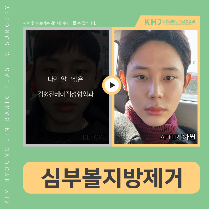 인모드 심부볼, 해결 안 되는 이유는 이거! 관련 이미지 4