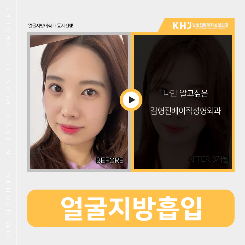 얼굴지방흡입전후 확실한 김형진베이직이죠? 관련 이미지 4