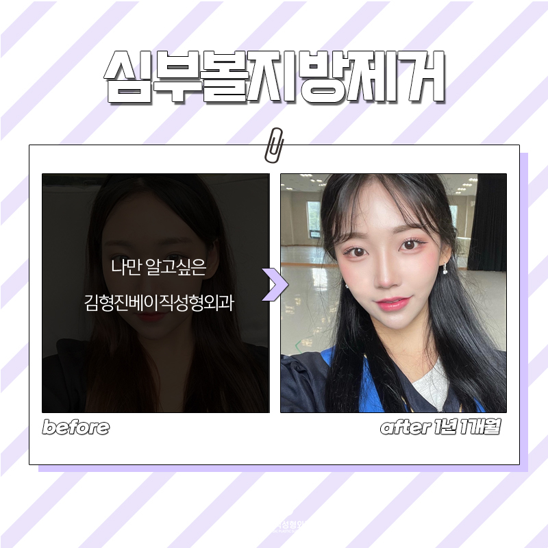 강남심부볼제거 볼살만 쏙 빼주니까 만족할 수 밖에 없죠 관련 이미지 6