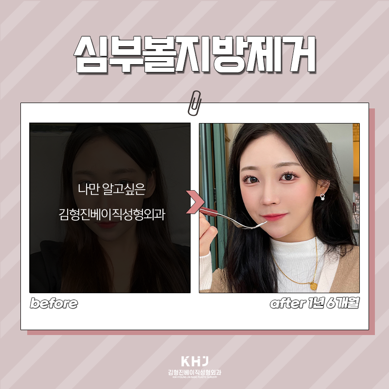 심부볼제거전후 궁금하셨다면 관련 이미지 7