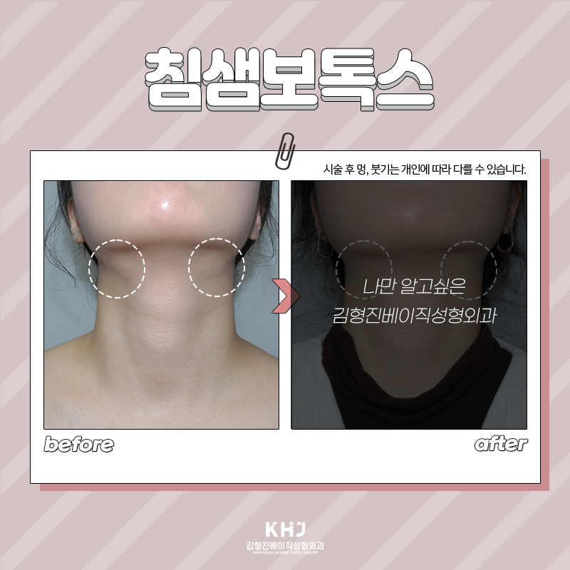 침샘보톡스유지기간 궁금하셨죠? 관련 이미지 5