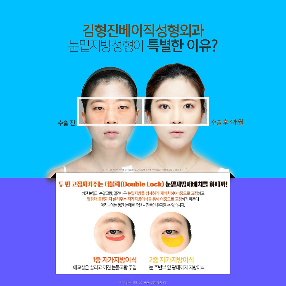 신사눈밑지 애교살 밑으로 접히는 눈 밑 지방 해결했어요 관련 이미지 5