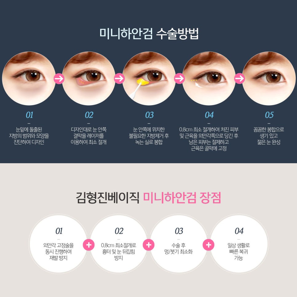 아직도 미니하안검효과 어떤지 모르세요? 관련 이미지 5