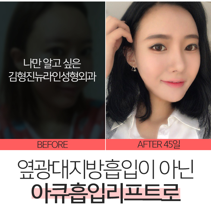 옆광대지방흡입 확실한건 아큐리프트다! 관련 이미지 5