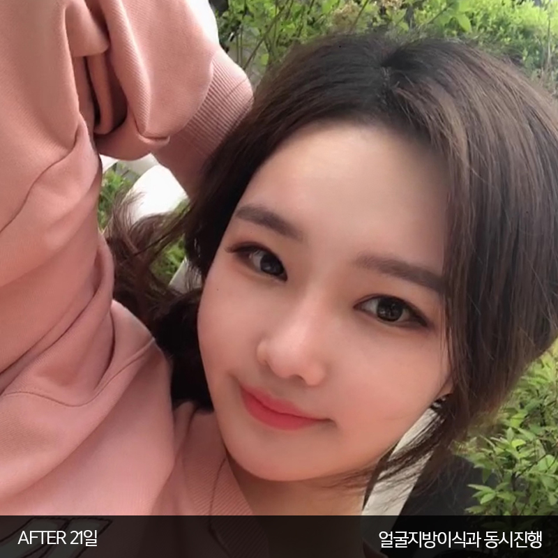얼굴지흡붓기 김형진베이직은 달라요 관련 이미지 5