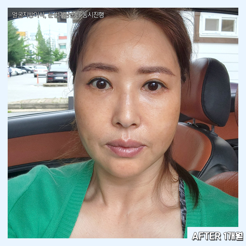 미니하안검흉터 걱정할 필요 없어요 관련 이미지 4