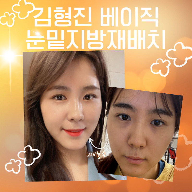 눈밑지방재배치효과 한 번으로 끝내야죠! 관련 이미지 6