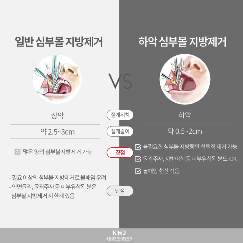 볼살없애는법 심부볼제거로 확실한 변화를 느껴보세요! 관련 이미지 5