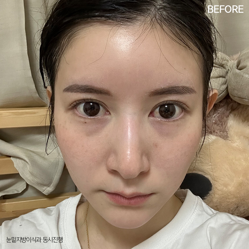 눈밑지방재배치효과 궁금하시죠? 관련 이미지 2