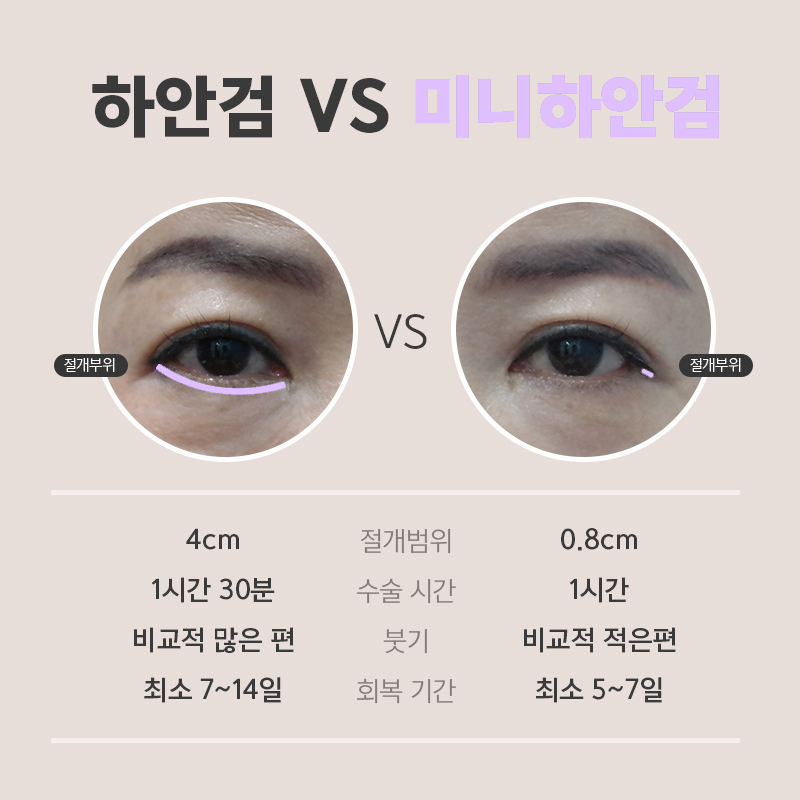 중년눈수술 걱정돼서 망설이고 있다면 관련 이미지 4