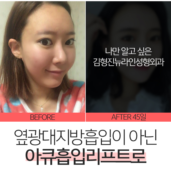 옆광대지방흡입 확실한건 아큐리프트다! 관련 이미지 2