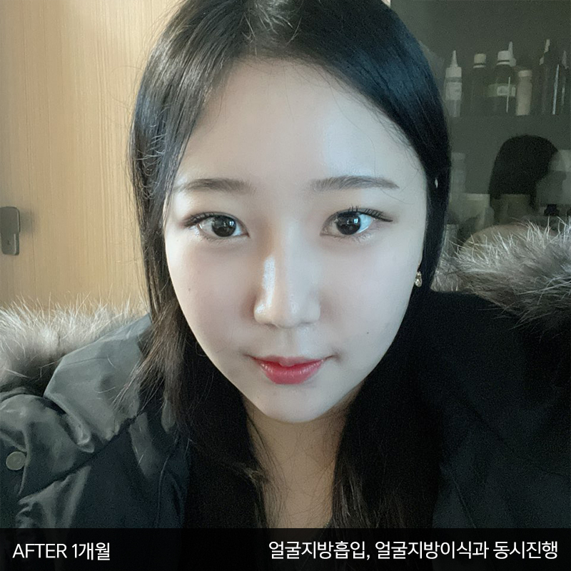 눈밑수술! 어떤건지 궁금하시죠? 관련 이미지 5