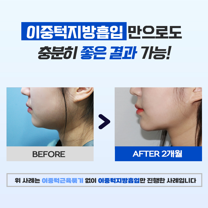 이중턱빼는법 다이어트로는 해결이 어려울까요? 관련 이미지 8