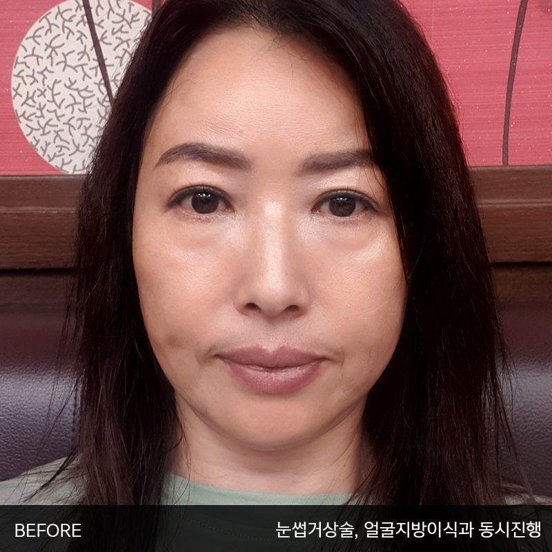 중년눈밑지방수술 아직 모르신다면 관련 이미지 2