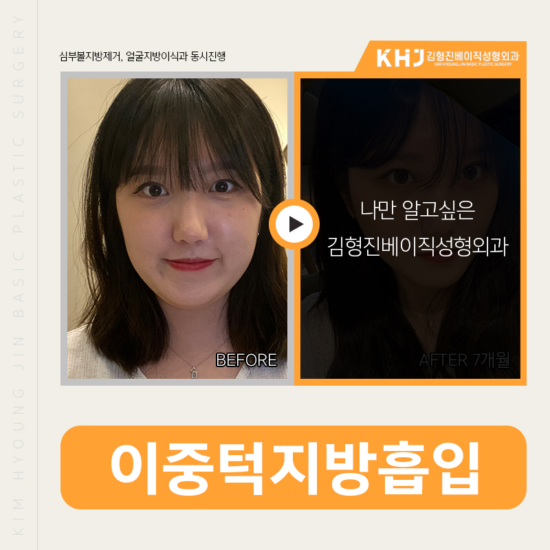이중턱지방흡입비용 부담되신다구요? 관련 이미지 3