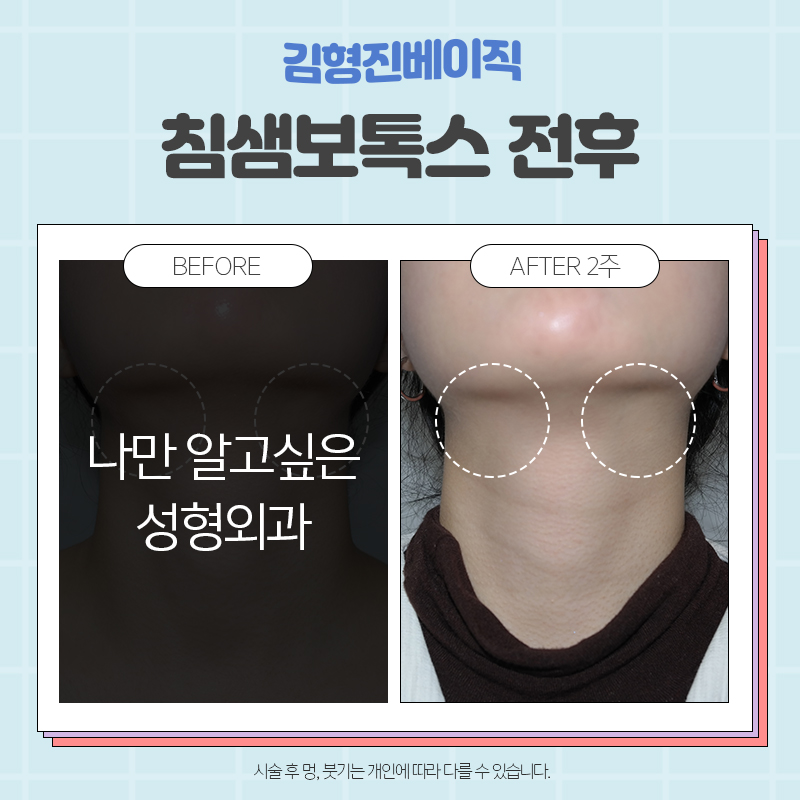 침샘보톡스전후 확실한곳, 김형진베이직 관련 이미지 5