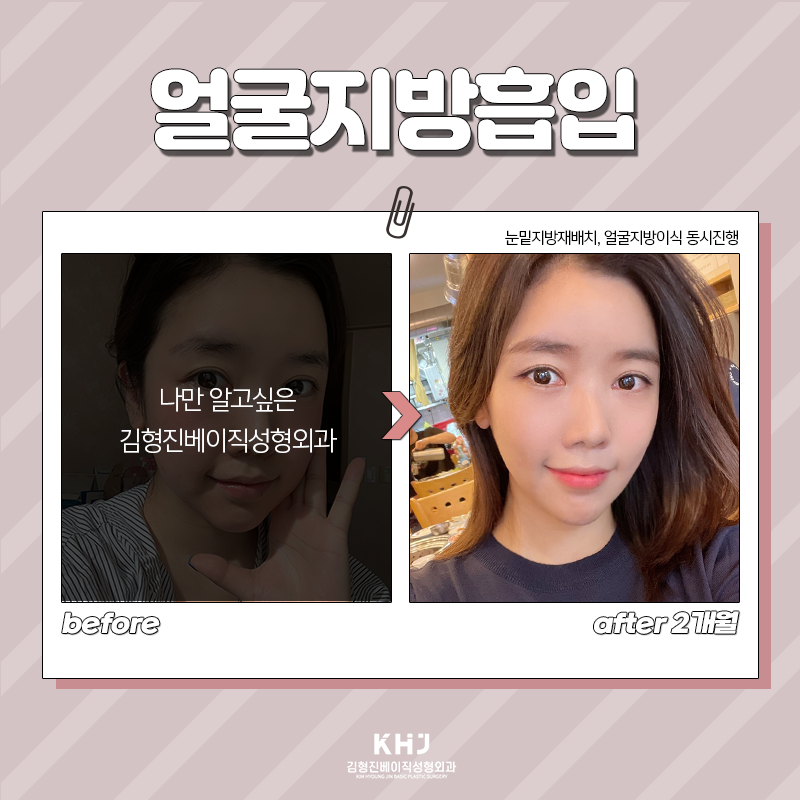 얼굴지방흡입방법 궁금하셨다면 관련 이미지 6