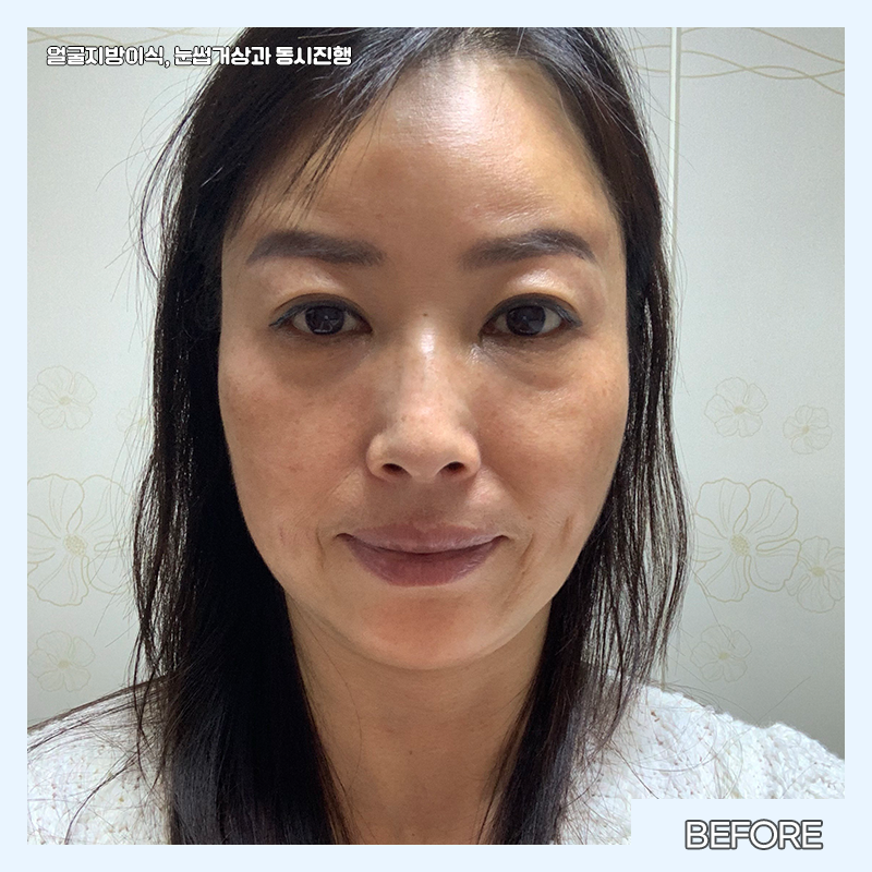 중년눈밑수술 김형진베이직에서 해야 하는 이유 관련 이미지 2