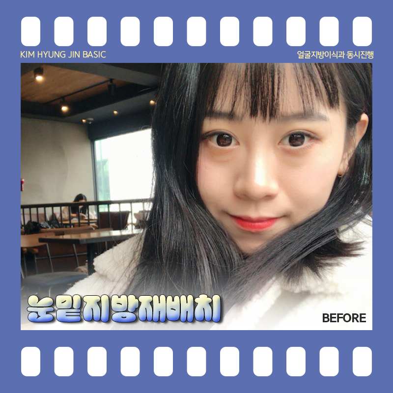 눈밑지방재배치통증! 걱정 안해도 되는 이유 관련 이미지 2