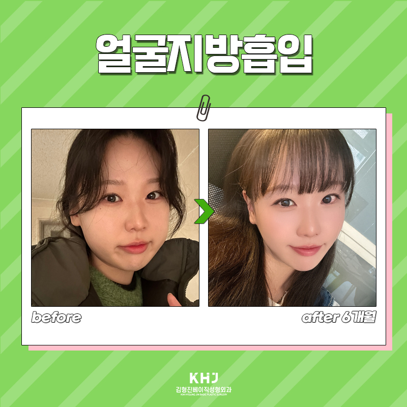 김형진베이직 얼굴지방흡입수술 변화 확실한 곳 관련 이미지 7