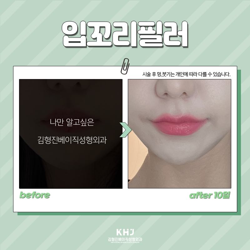 입꼬리필러전후 보여드립니다! 관련 이미지 6