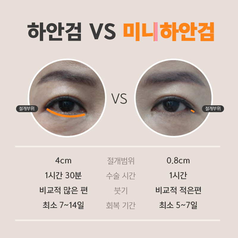 중년눈수술전후 잘하는 병원 알아보는 중이라면 관련 이미지 4