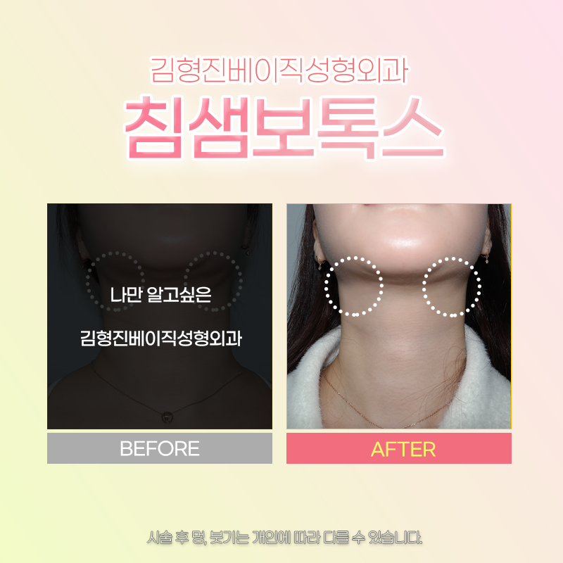 침샘보톡스전후 확인하고 가실래요? 관련 이미지 4