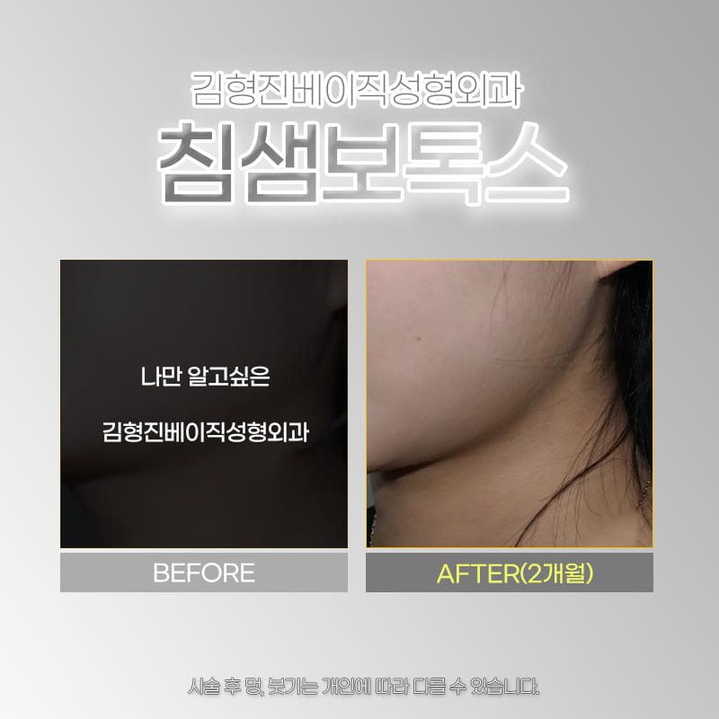 침샘보톡스전후 돌고 돌아 결국 여기였어요 관련 이미지 6