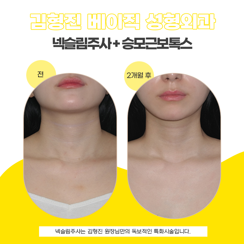 Neckline Care: If Your Trapezius Line Looks Blunt image 5