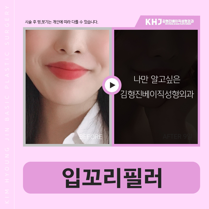 압구정입꼬리필러 하나로 인상이 완전히 달라졌어요ㅠㅠ 관련 이미지 6