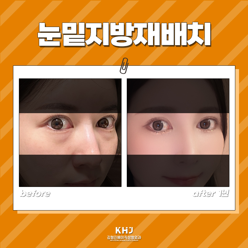 눈밑지전후 차이가 확실한 곳에서 관련 이미지 6