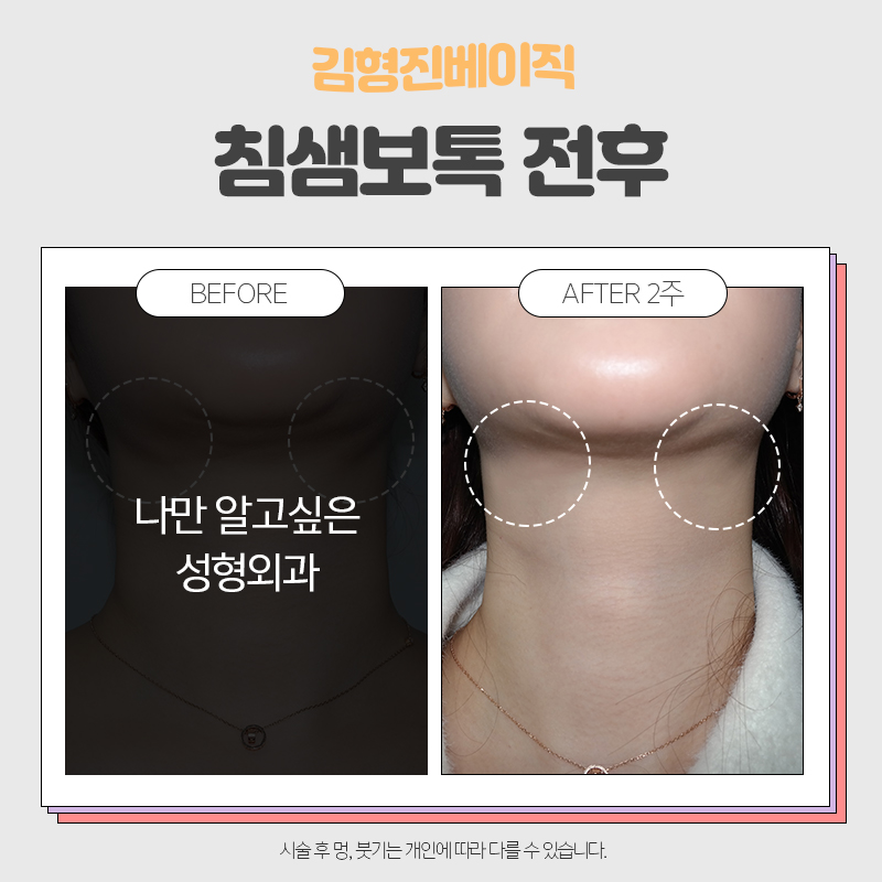 턱밑침샘보톡스효과 모르면 안돼죠 관련 이미지 6