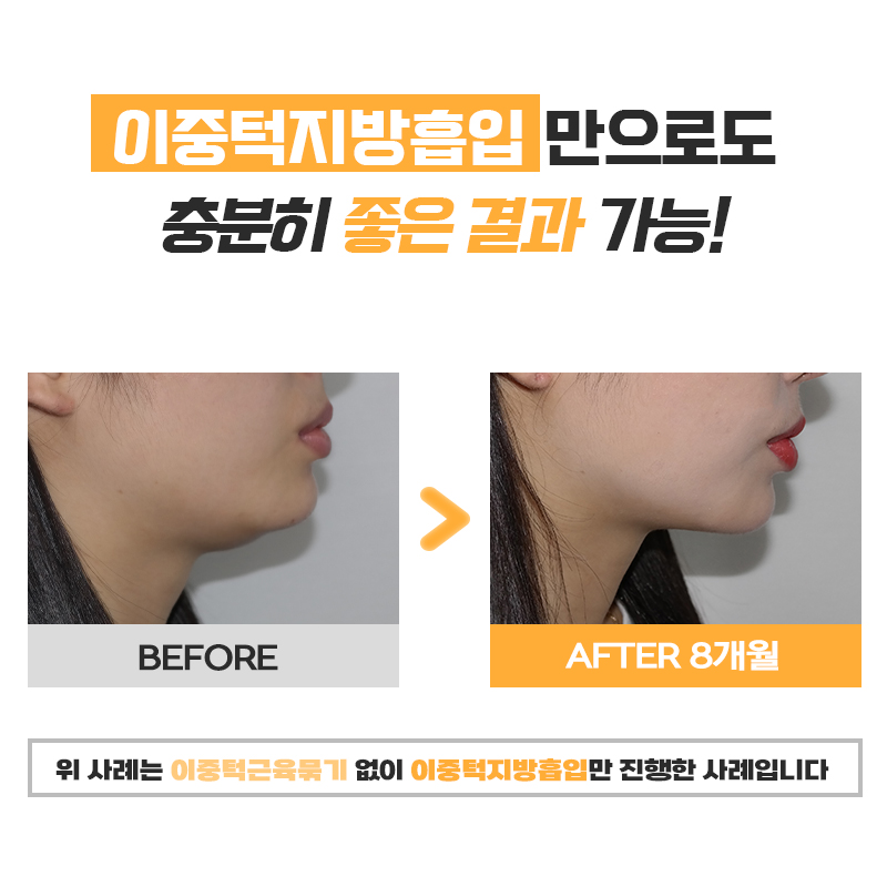 얼굴지흡효과 이렇게나 확실한데 아직도 망설이고 있다면 관련 이미지 6