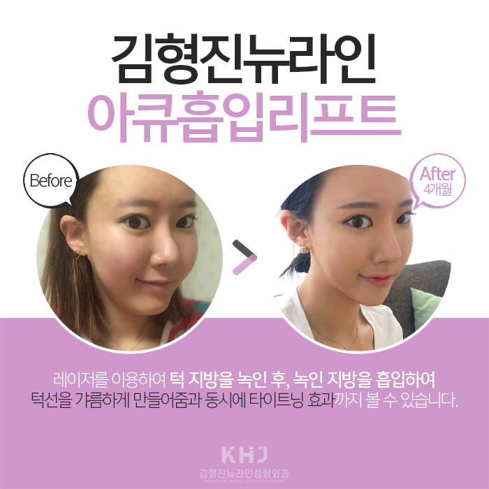 턱살지방흡입후기 확실한 곳 찾아요? 관련 이미지 5