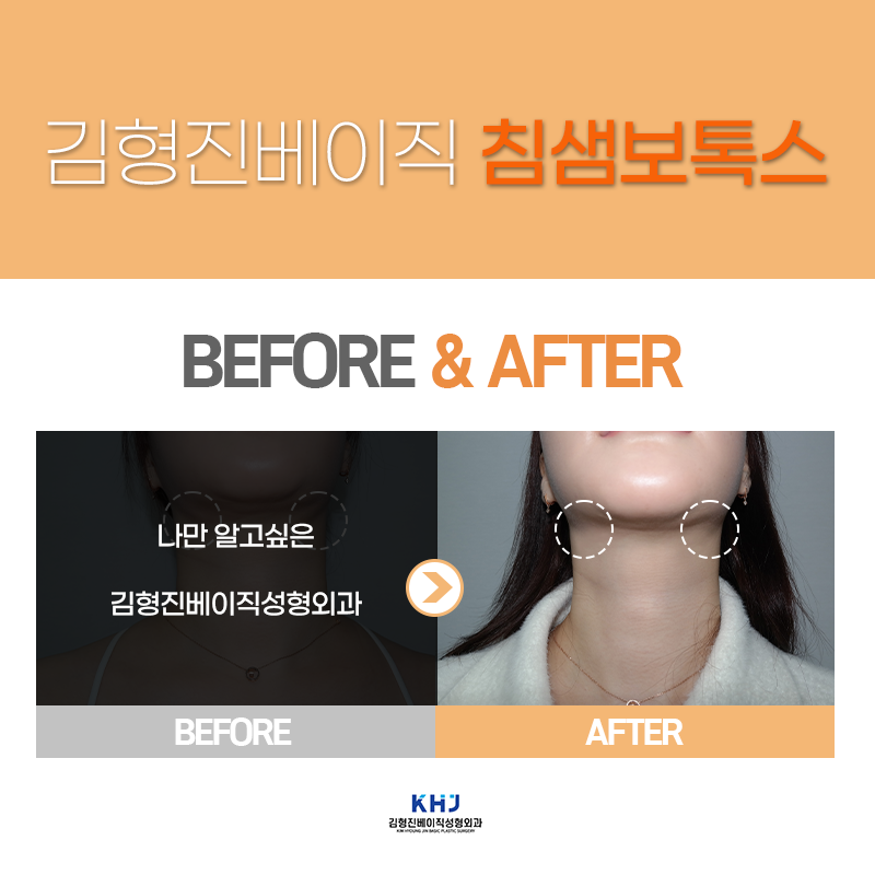 턱밑침샘보톡스효과 확인하고 가세요! 관련 이미지 4