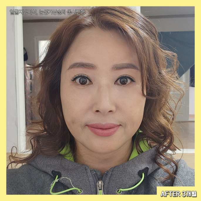 중년눈밑성형 아직도 고민하신다면 관련 이미지 6