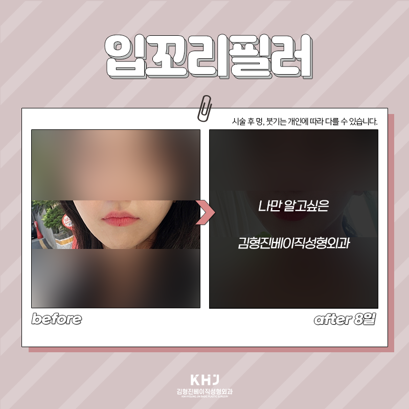 입꼬리비대칭 개선하는 방법 찾으셨다면 관련 이미지 3