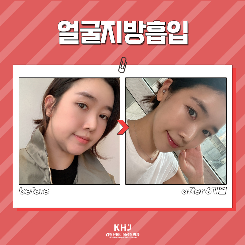 얼굴살빼는방법 한 번에 해결해 드릴게요! 관련 이미지 7